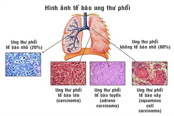 6. Các tiến bộ mới trong điều trị ung thư phổi